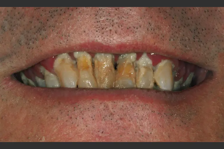 Implantes dentales - Caso clínico 1 despues