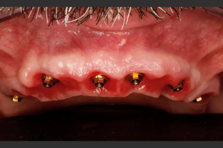 Implantes dentales - Caso clínico 10 después
