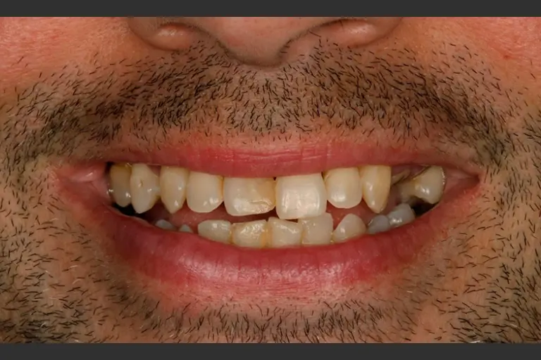 Implantes dentales - Caso clínico 11 después