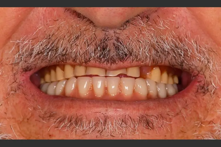 Implantes dentales - Caso clínico 7 después