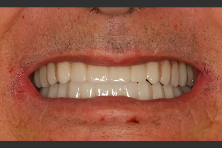 Implantes dentales - Caso clínico 7 después