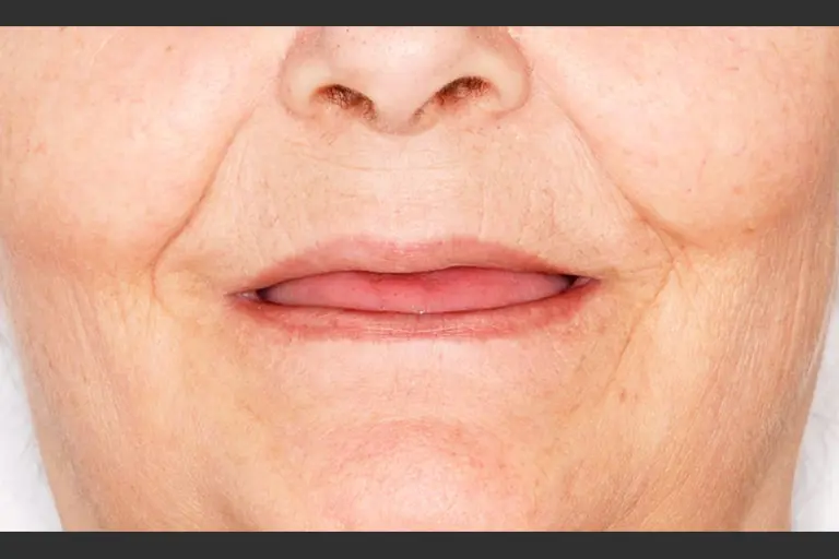 Implantes dentales - Caso clínico 8 después