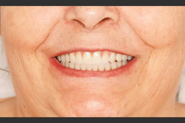 Implantes dentales - Caso clínico 8 después