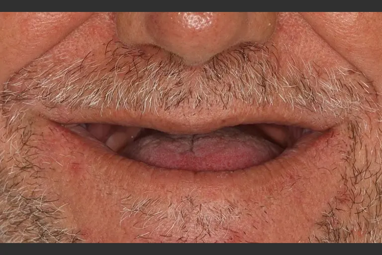 Implantes dentales - Caso clínico 9 después