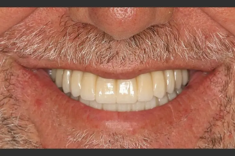 Implantes dentales - Caso clínico 9 después