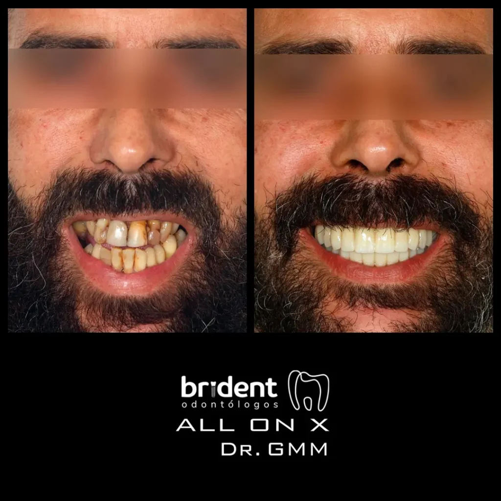 ALL ON X - Superior e inferior, Rehabilitación total con implantes dentales