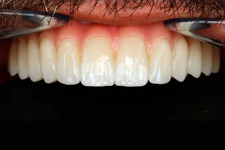 Implantes dentales - Caso clínico 11 después