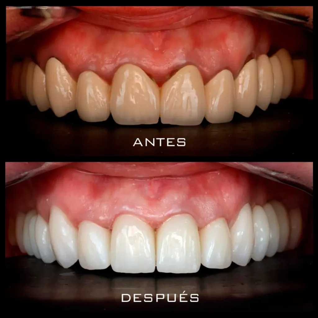Carillas Dentales - Antes y después