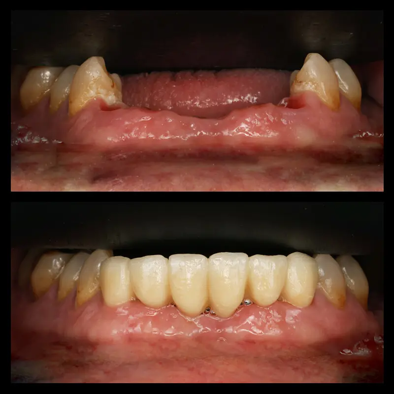 Antes y después de implantes mínimamente invasivos