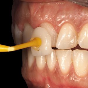 Carillas dentales - Estética dental